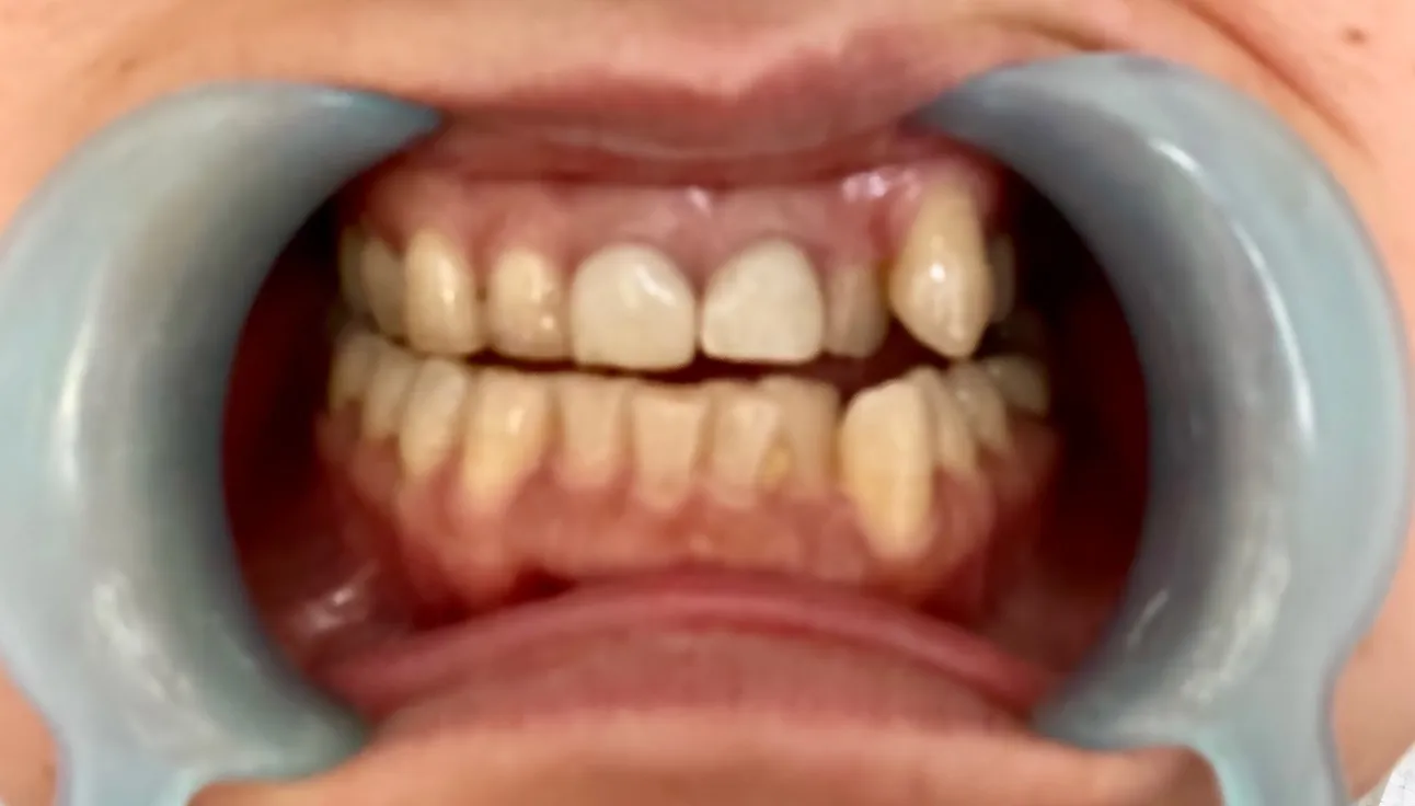 本日は、久しぶりに歯のディープクレンジングです。