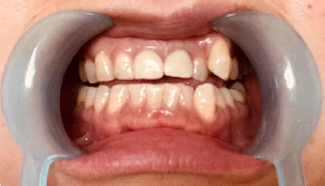 本日は、久しぶりに歯のディープクレンジングです。