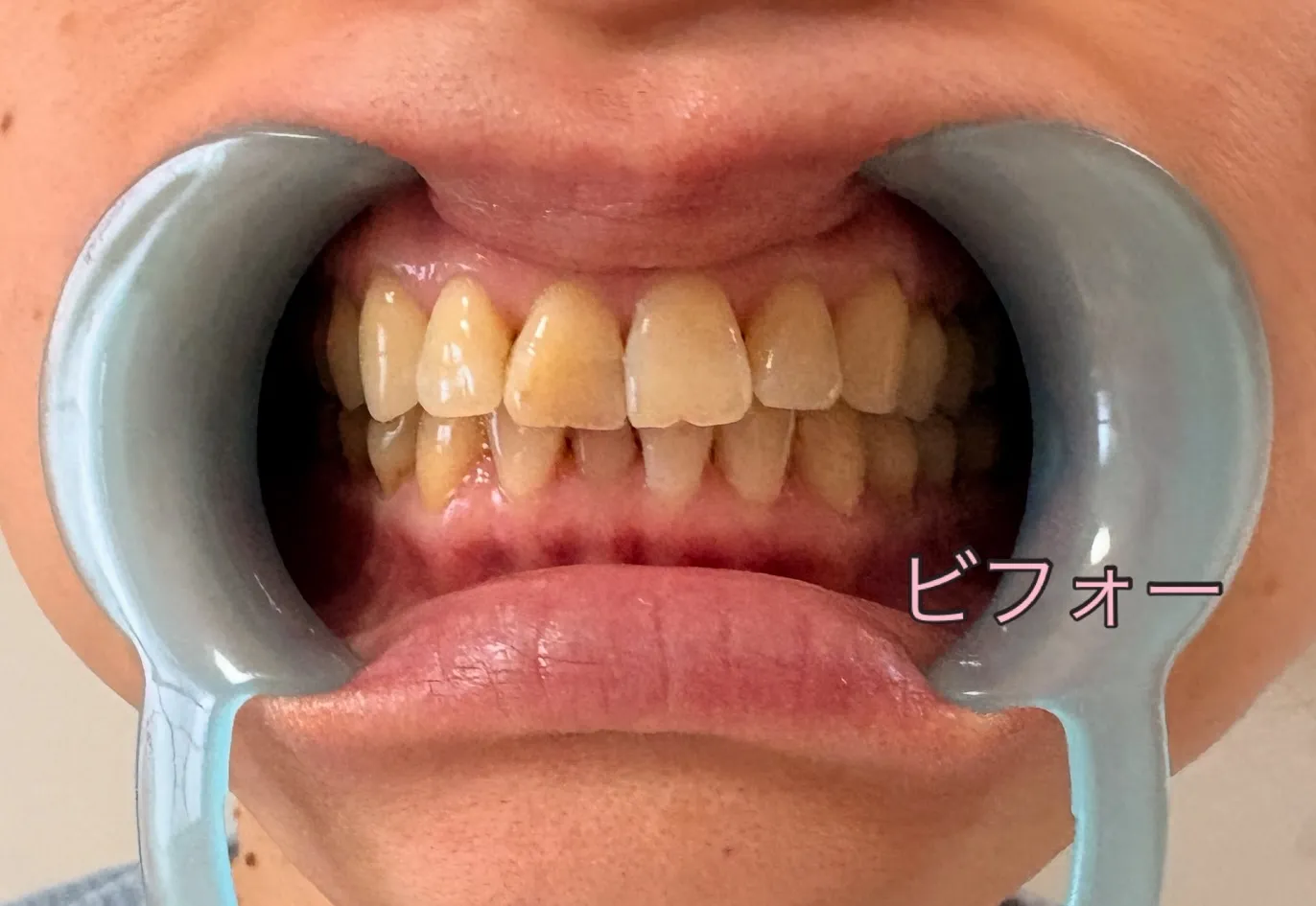 本日は、ちょっと意外なお話です🦷